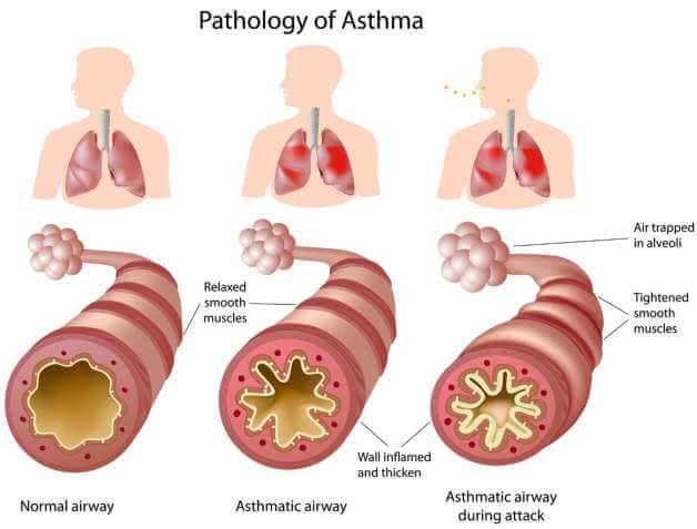 astma