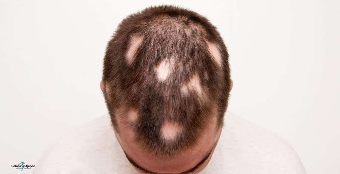 Alopecija Areata