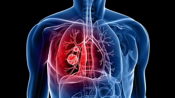 Rak pluća - uzrok, simptomi i kako ga sprječiti.