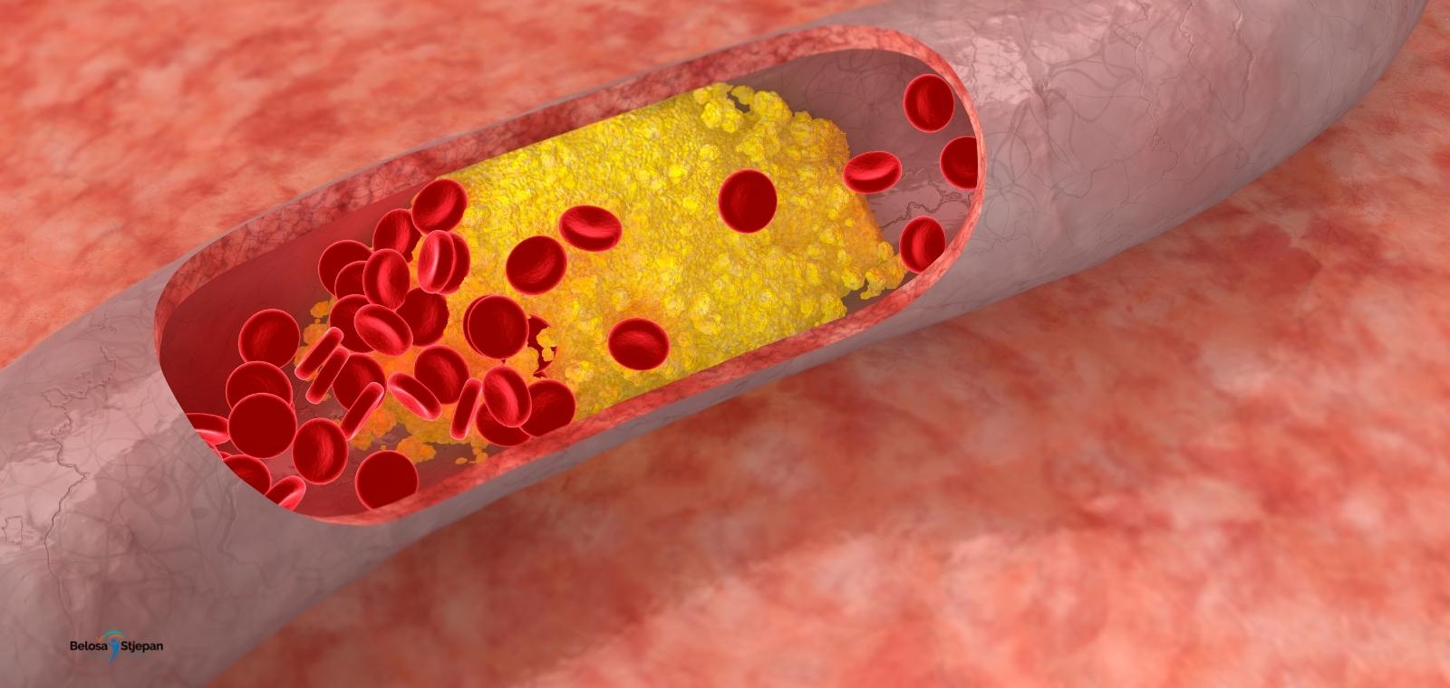 Masnoća u krvi povišeni kolesterol
